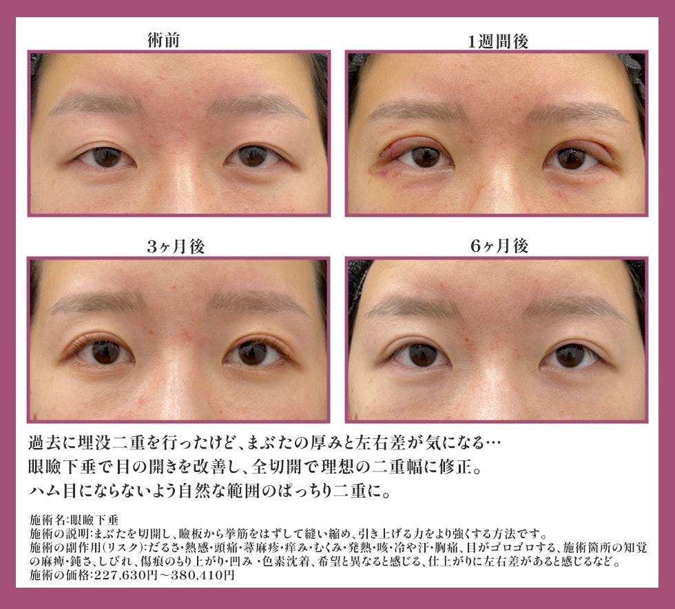 眼瞼下垂＋タルミ取り併用全切開<br />
