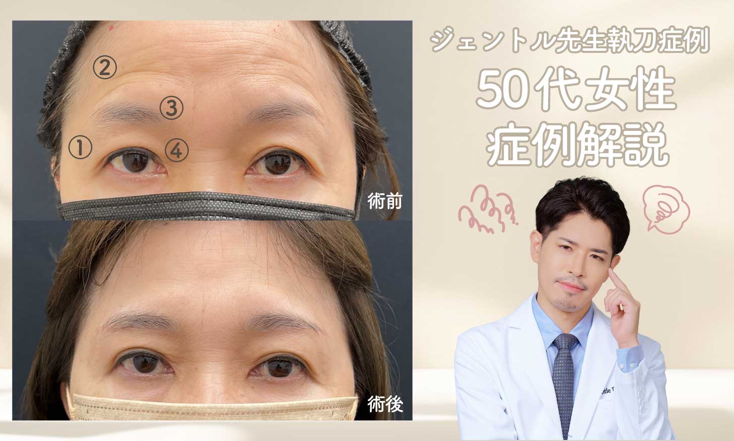 実際に眉下リフトを受けて頂いた50代女性の症例で解説！