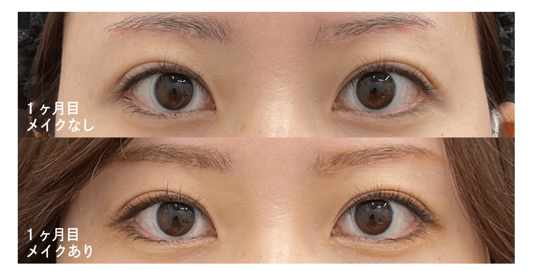 ダウンタイム〈1ヶ月後〉