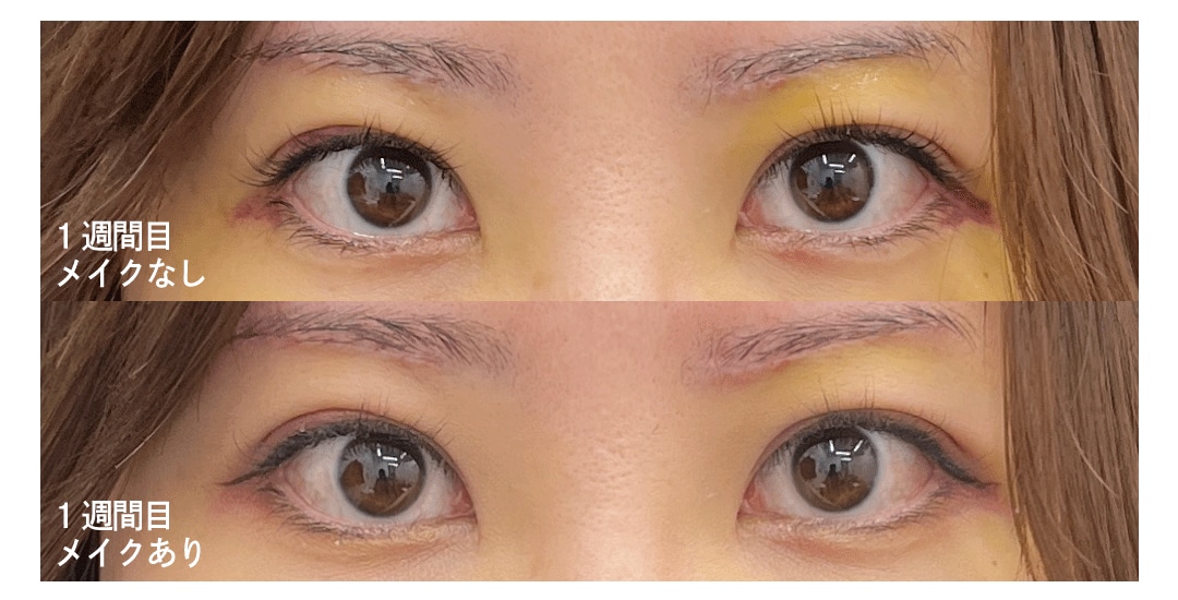 ダウンタイム〈1週間後・抜糸日〉