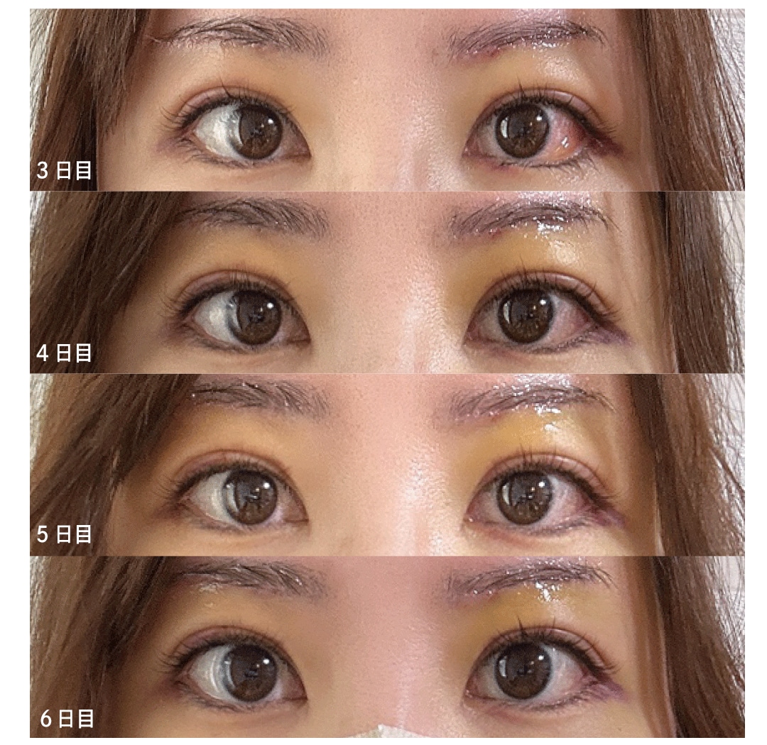 ダウンタイム〈3日目〜６日目〉