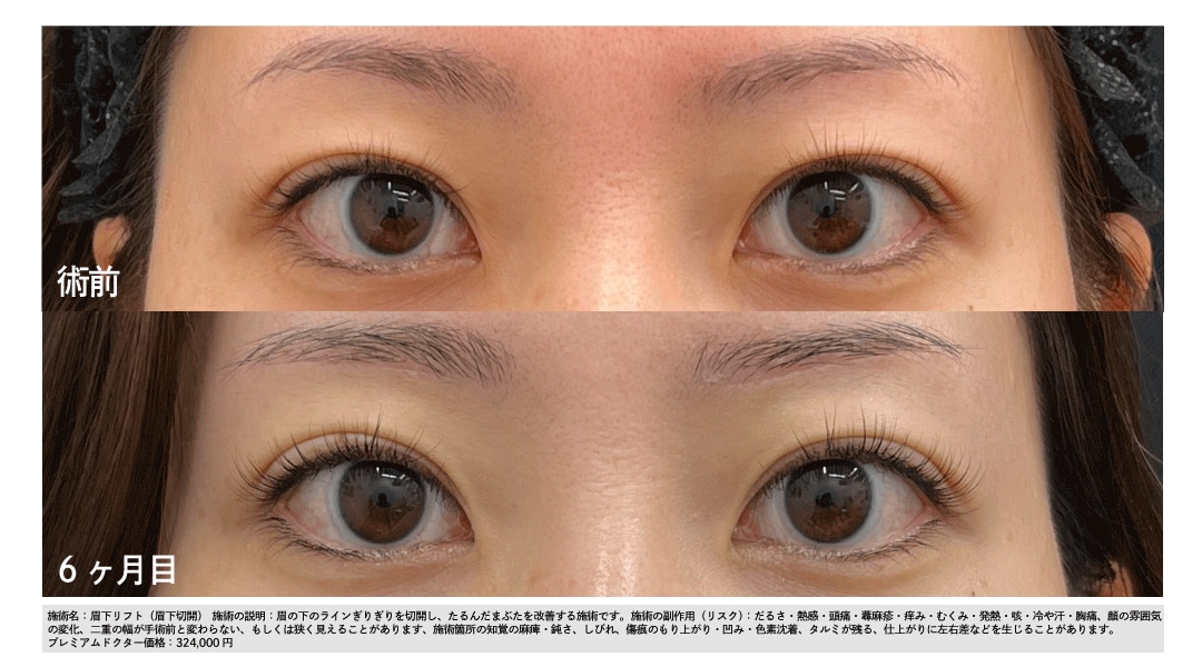 ダウンタイム〈6ヶ月後〉