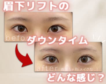眉下リフト(眉下切開)はジェントル滝澤!~目元のお手術・垢抜けお任せください~【目元若返りはSBC表参道院】