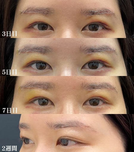 ダウンタイム【3日目・5日目・1週間・2週間】