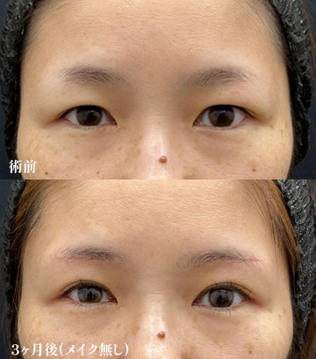 眉下リフト×ROOF切除
