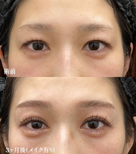 眉下リフト×目頭切開or目上リフト