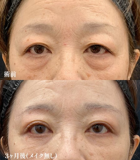 眉下リフト×クマ取り