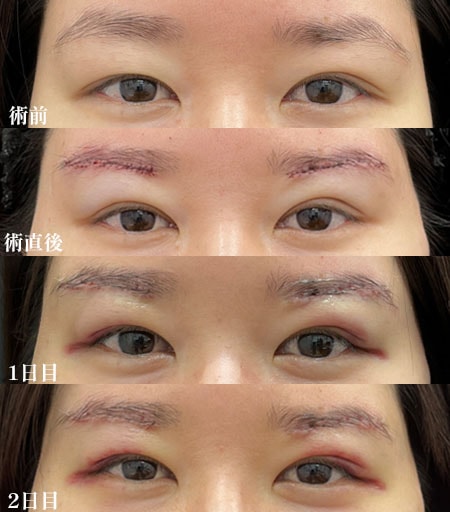 ダウンタイム【術前〜2日目】