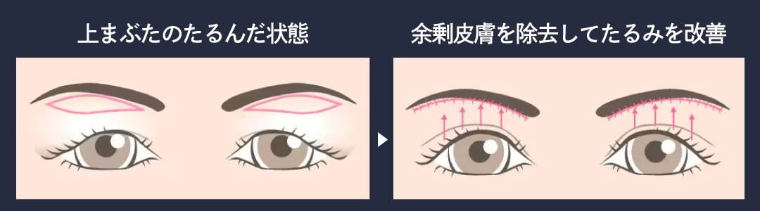 眉下リフト(眉下切開)ってどんな治療？