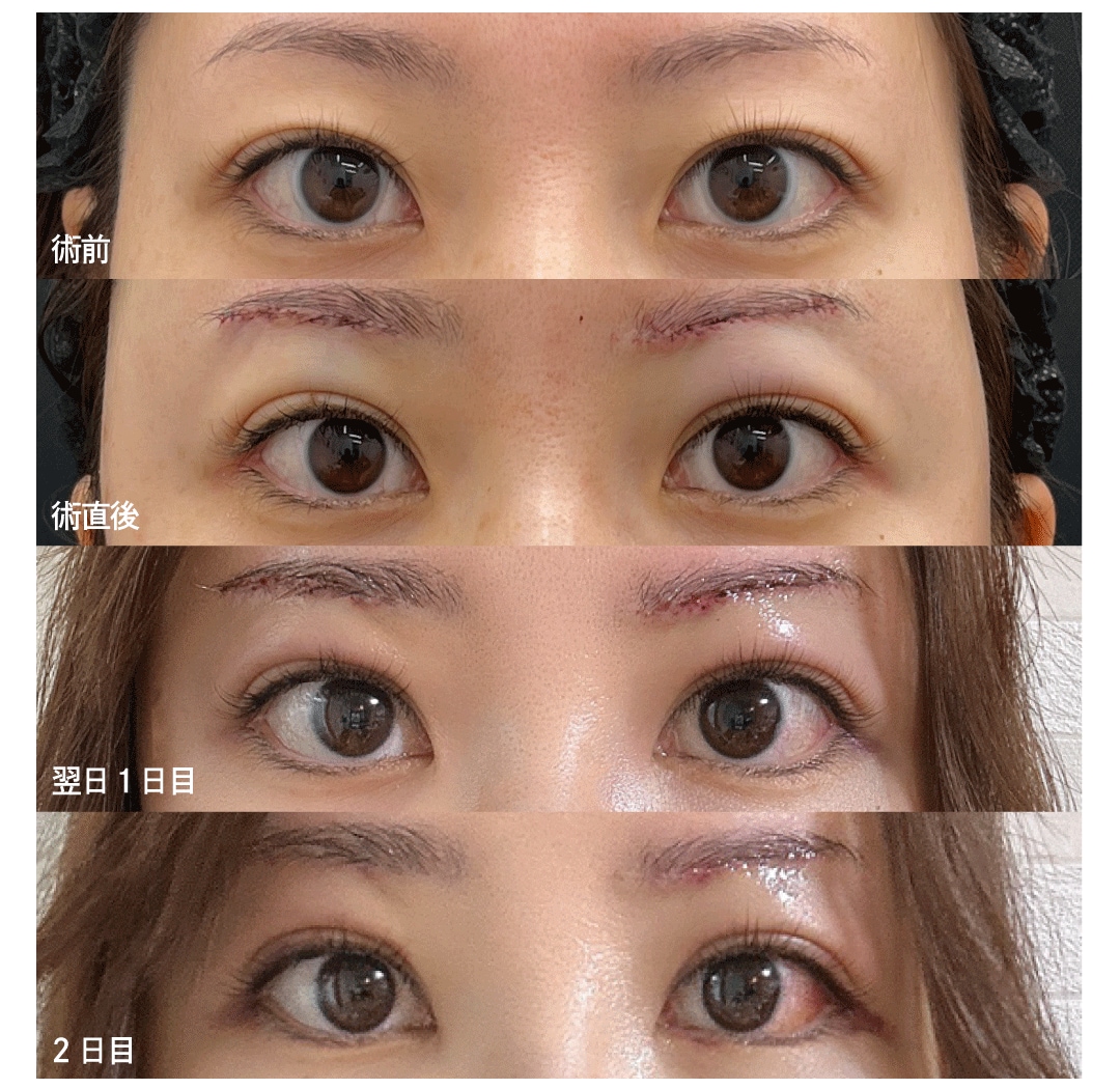 ダウンタイム〈術前〜2日目〉