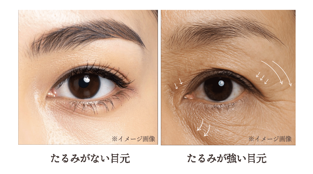 まぶたのたるみは、主に次の3つの原因で起こります
