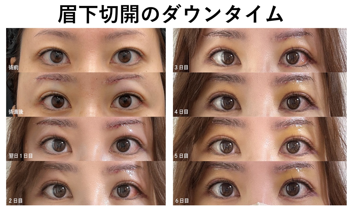 Case5 術後の内出血・腫れが長引く