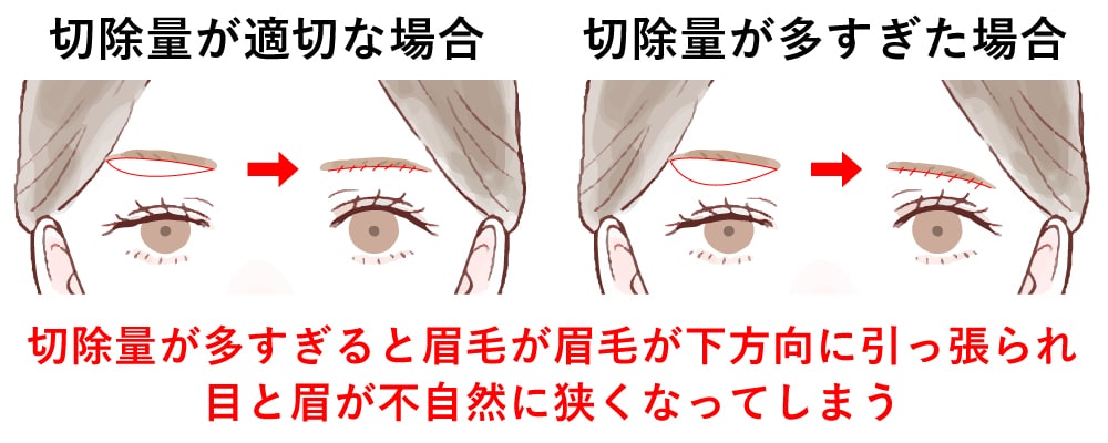 Case1 目と眉の距離が近くなりすぎる
