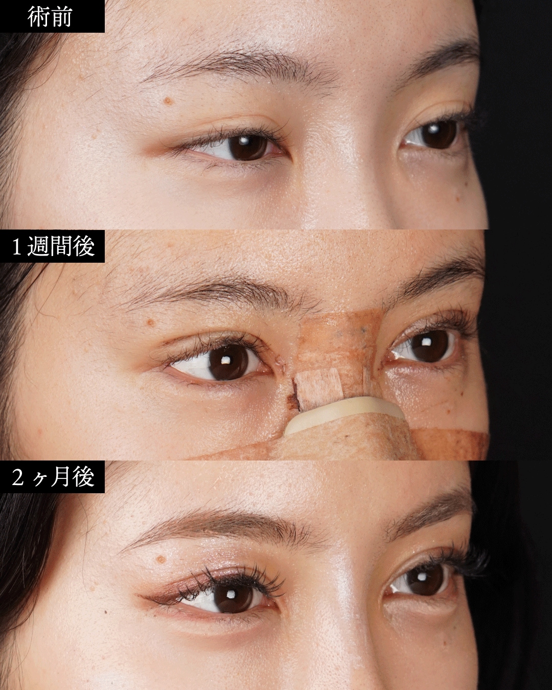 表参道Oculus院_小林諒佳さん症例写真