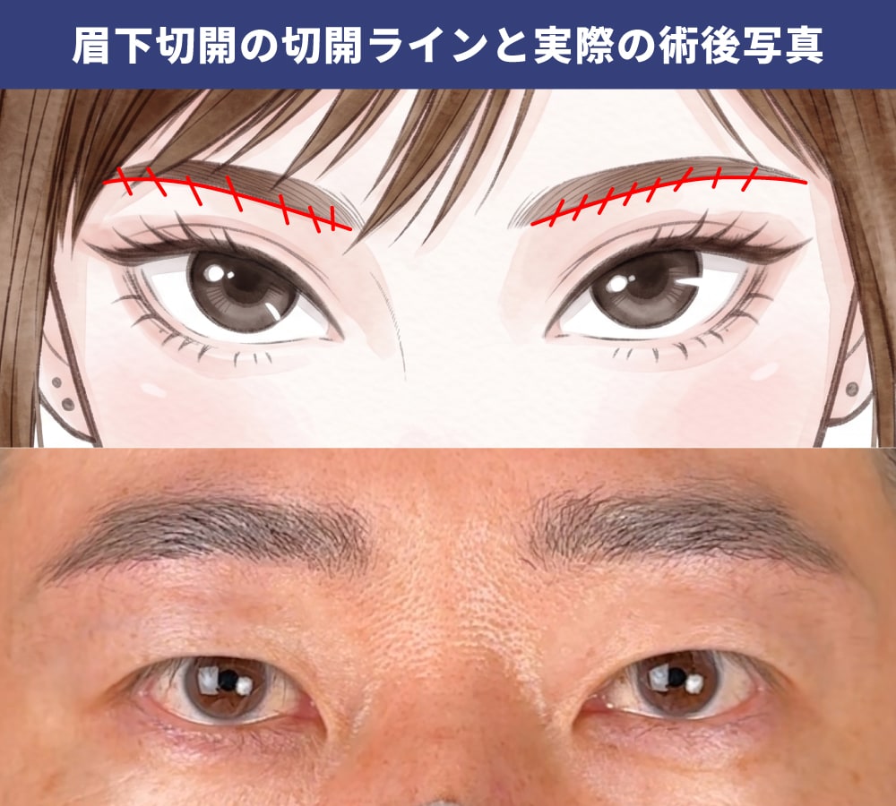 眉下切開（眉下リフト）とは｜なぜ男性に向いているのか