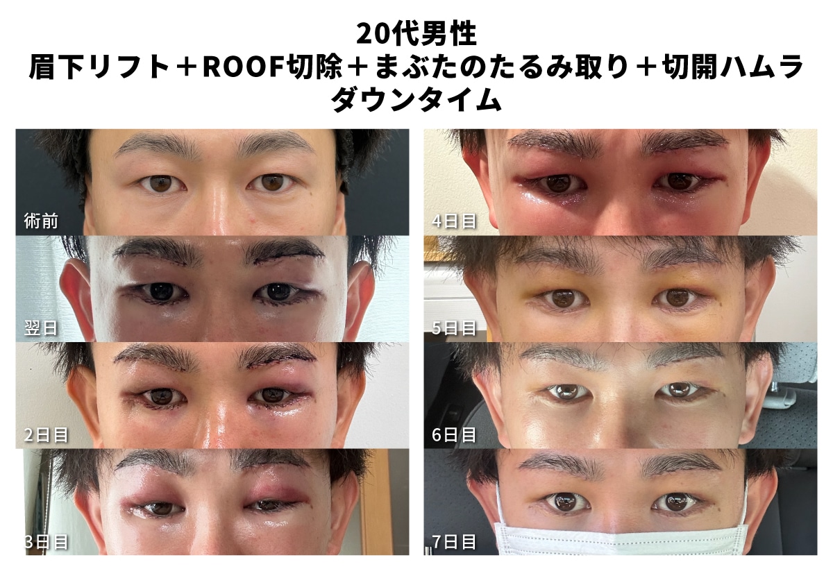 ③仕事を長く休めないが、ダウンタイムはどのくらいか