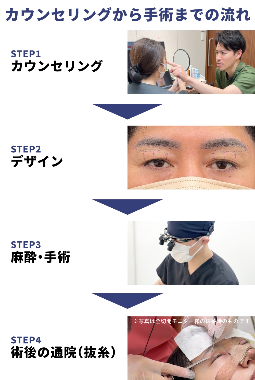 眉下切開のカウンセリングから手術までの流れ