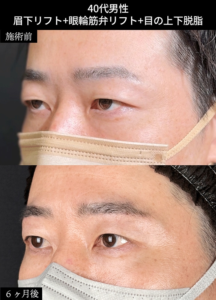 ②一重のまま、厚み・腫れぼったさだけ取れるか