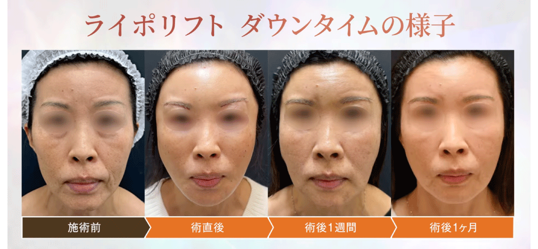 気になるダウンタイムと腫れの様子