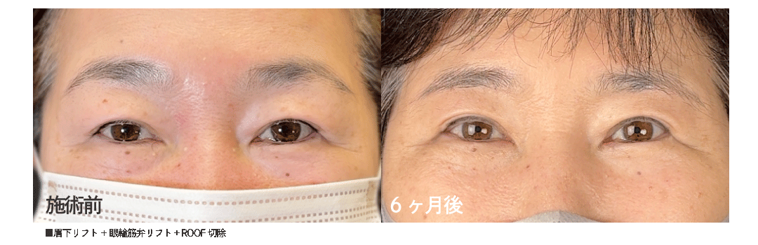 眉下切開リフトプレミアムの3つの特徴