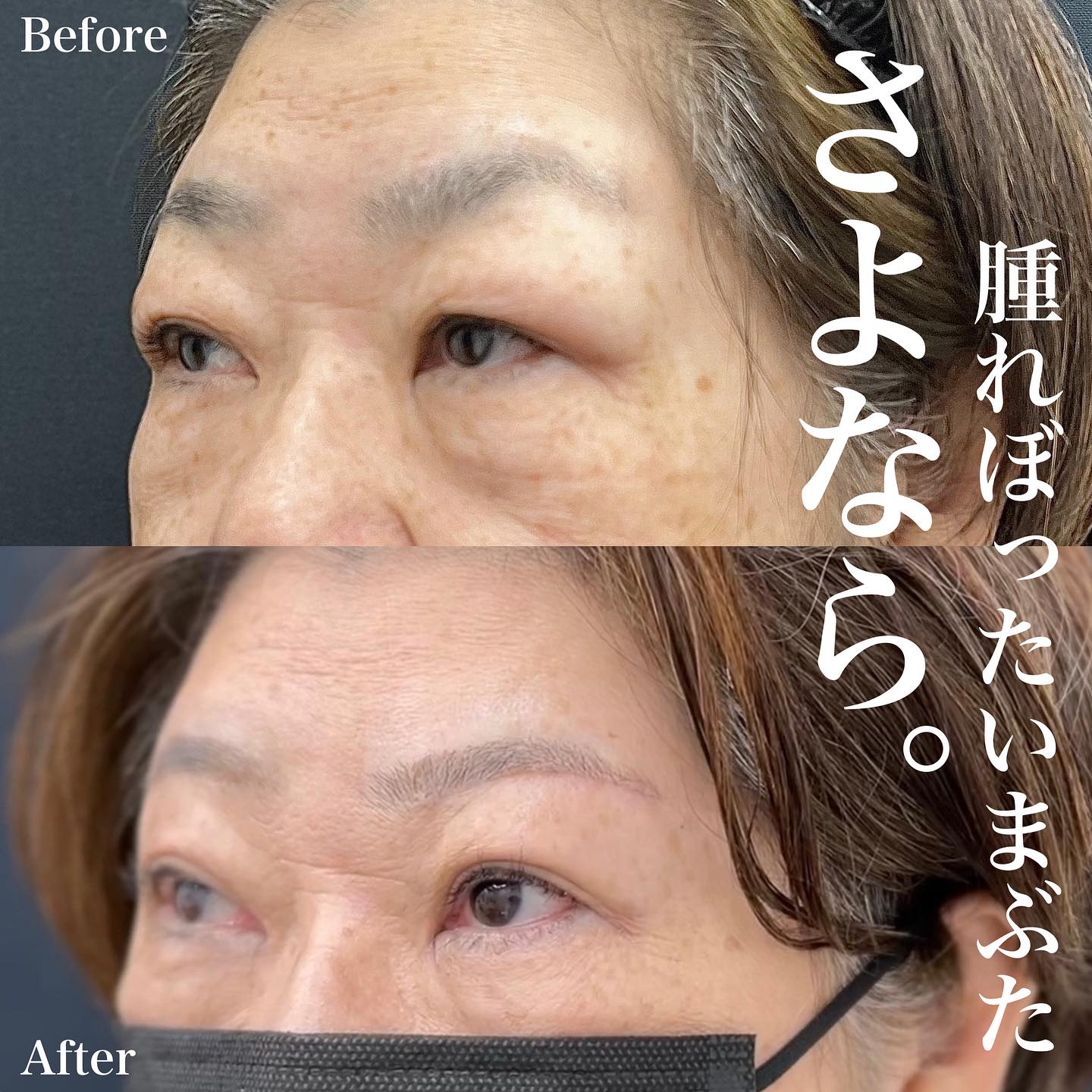 60代女性症例：眉下リフト＋ROOF、眼窩脂肪切除