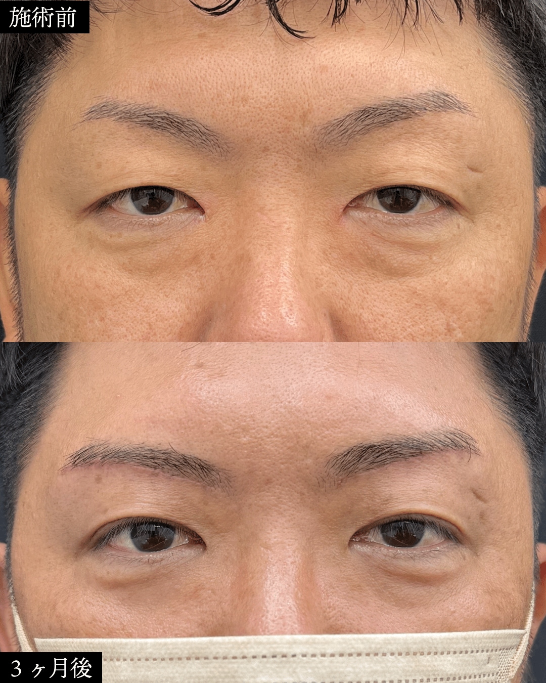 40代男性症例：眉下リフト＋ROOF切除＋クマ取り
