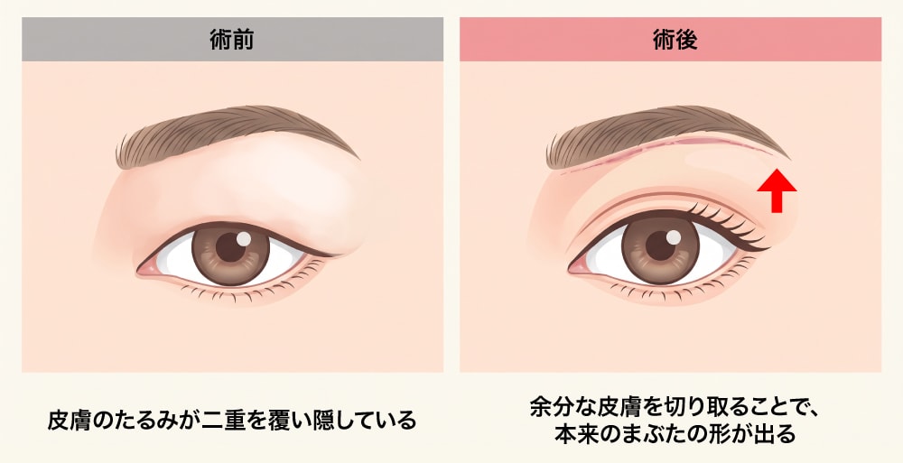 奥二重・隠れた二重だった方の場合