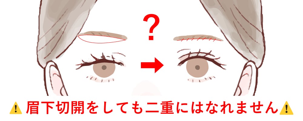 二重にしたい方へ｜眉下切開だけでは二重になりません