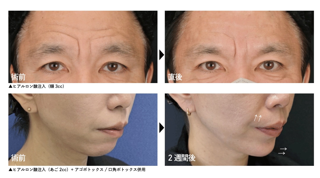 切らない若返り施術：ヒアルロン酸