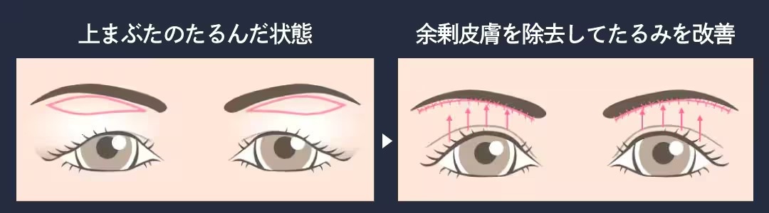 施術で介入する部位は、まぶたではなく眉下