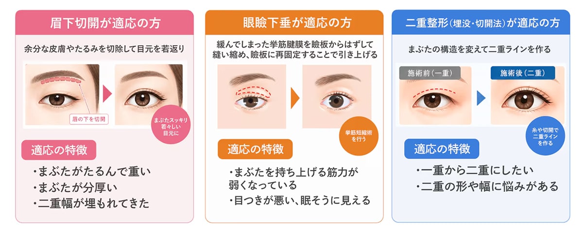 眉下切開と眼瞼下垂、二重埋没との構造的な違い