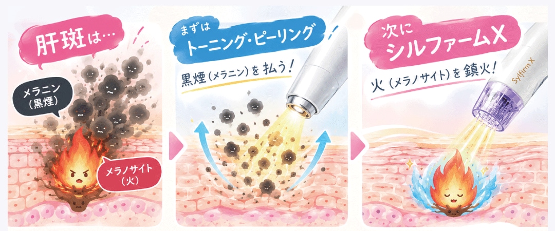 なかなか治療が難しい肝斑も改善できるのが大きな特徴！