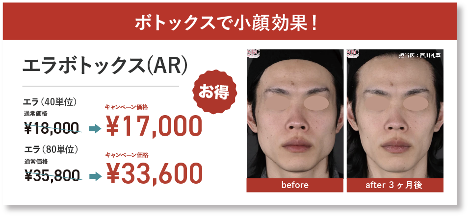 ボトックス