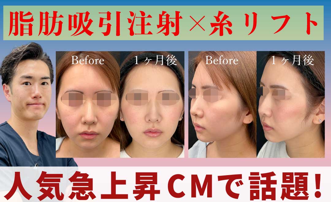脂肪吸引注射×糸リフト