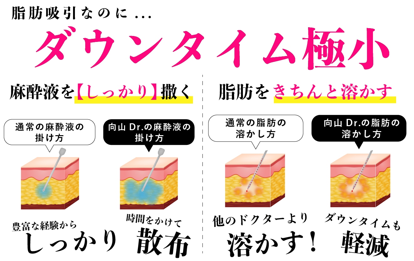 脂肪吸引注射と同じダウンタイムで、最大の効果を引き出す