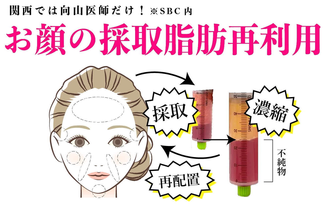関西では向山医師だけ！顔の採取脂肪再利用 ※SBC内