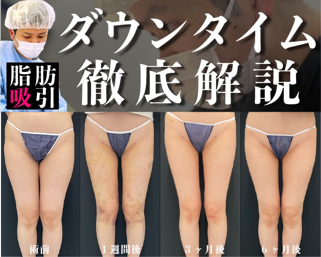 【脂肪吸引/ダウンタイム】大阪堺東「新」院長向山直樹医師の”こっそり部分痩せ”ダウンタイム公開！