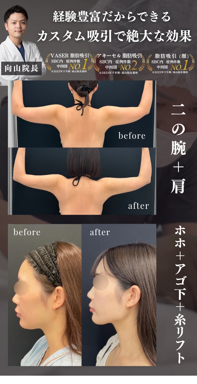 脂肪吸引で「キレイ」に部分痩せ‼️