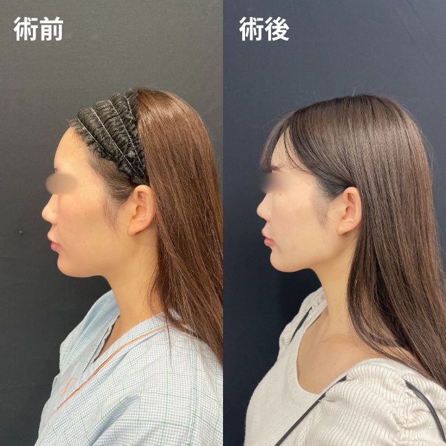 顔脂肪吸引（ホホ＋アゴ下）＋糸リフト