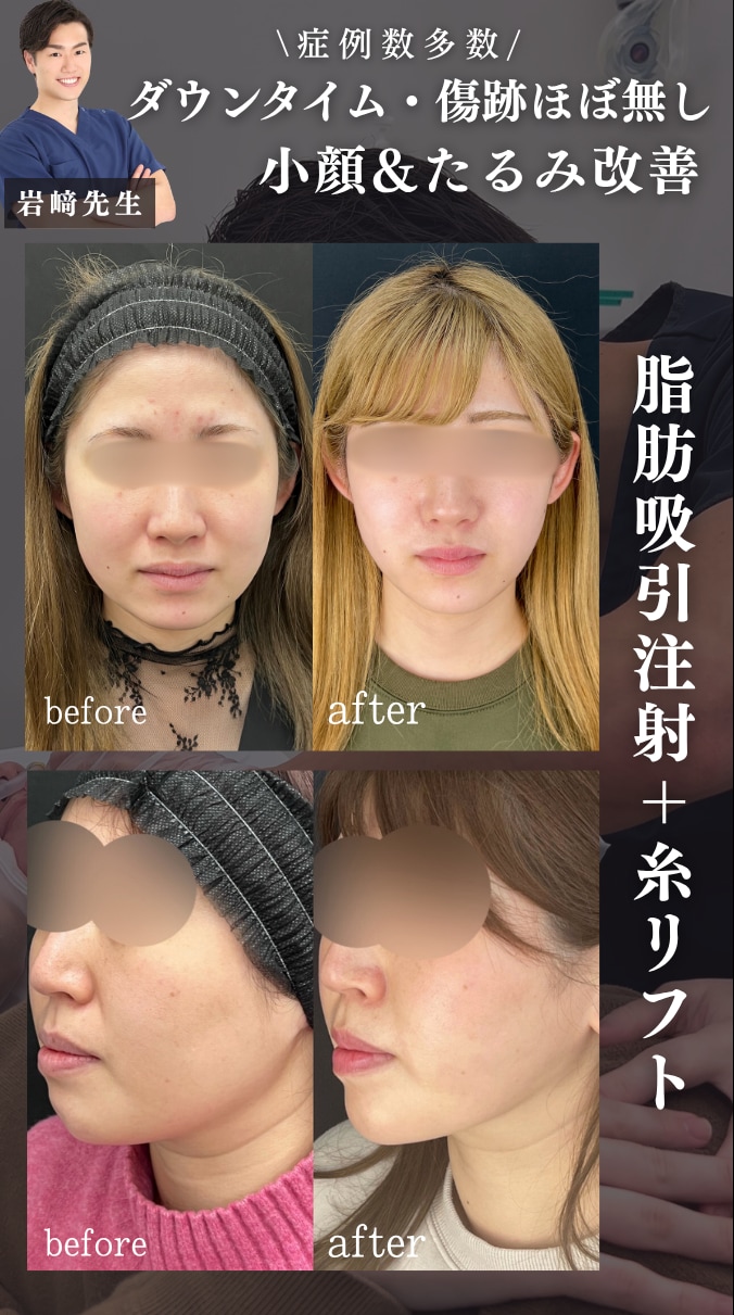 脂肪吸引注射＋糸リフト🪡