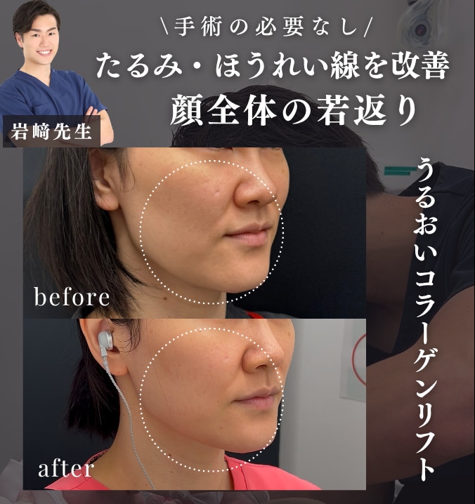 【外科治療必要なし】うるおいコラーゲンリフト🫧