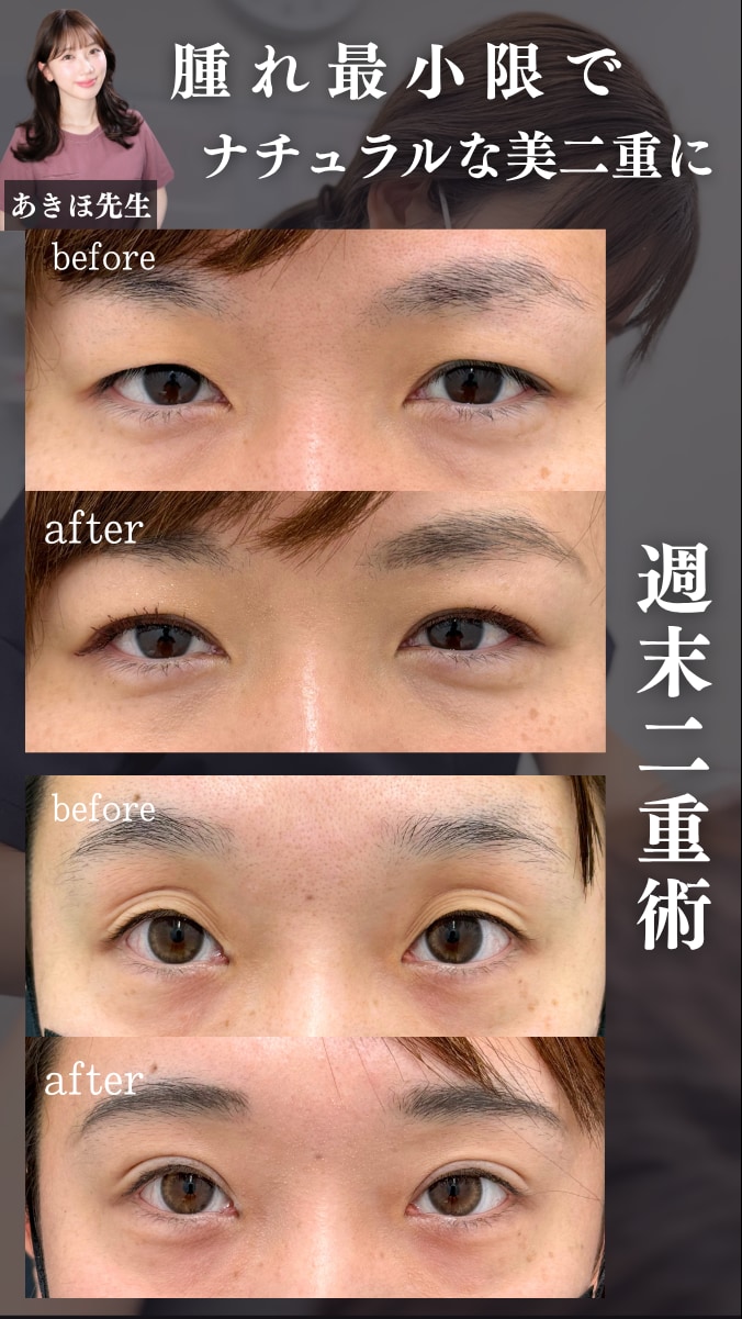 コスパ最強🔥週末二重術