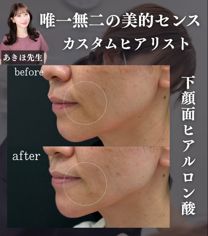ヒアルロン酸施術で即”かわいい”💓