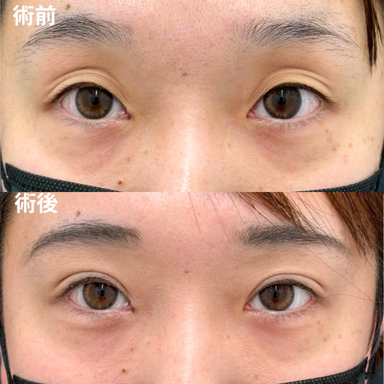 週末二重術