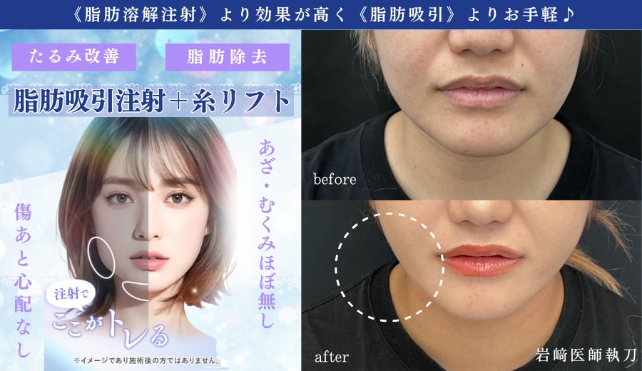 脂肪吸引よりお手軽&脂肪溶解注射よりも効果は大🌟