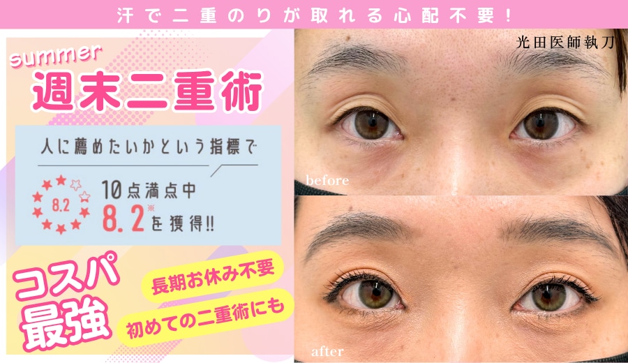 初めての二重デビューで二重のり卒業👏