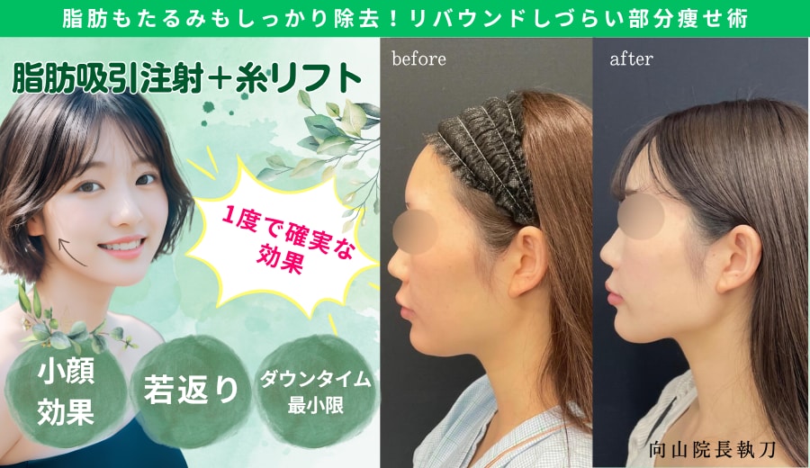 最大脂肪除去率90%🌟1度で確実な変化💞