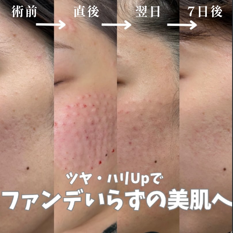 女優注射のダウンタイムは？