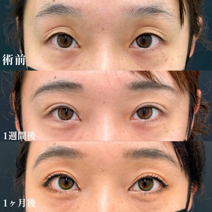【週末二重術】ダウンタイム経過