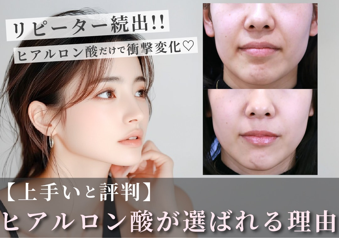 【ヒアルロン酸が上手いと大阪で評判】湘南美容クリニック大阪堺東院が選ばれる理由